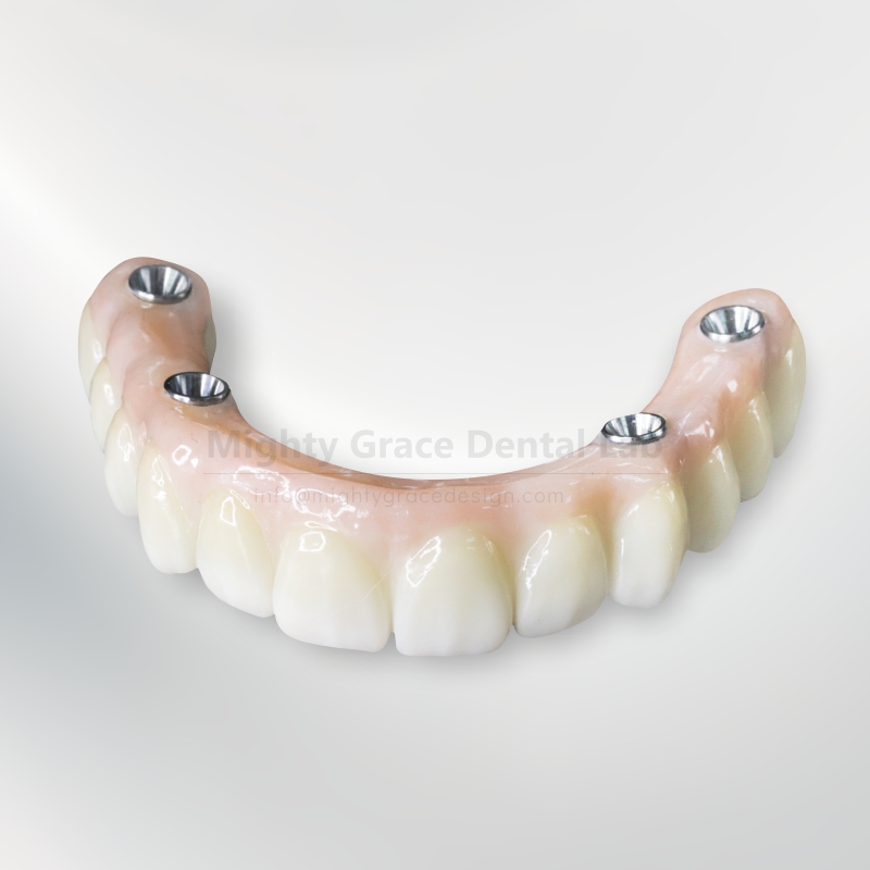Implant-supported Denture