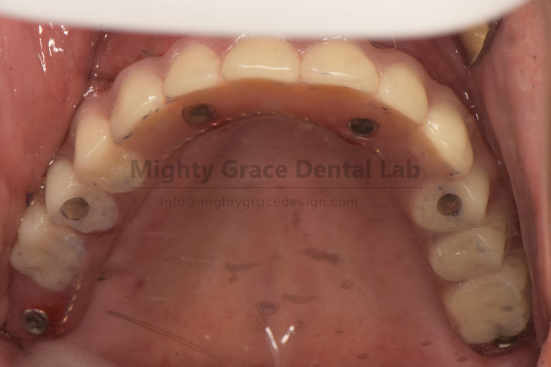 All-On-4 Dental Implants: Regain a Full Set of Teeth in a Single Day