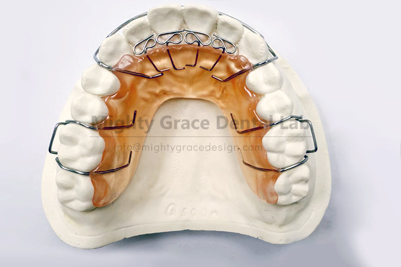 Spring Activator: Early Intervention for Localized Crossbite in Children, Guiding Proper Tooth Growth