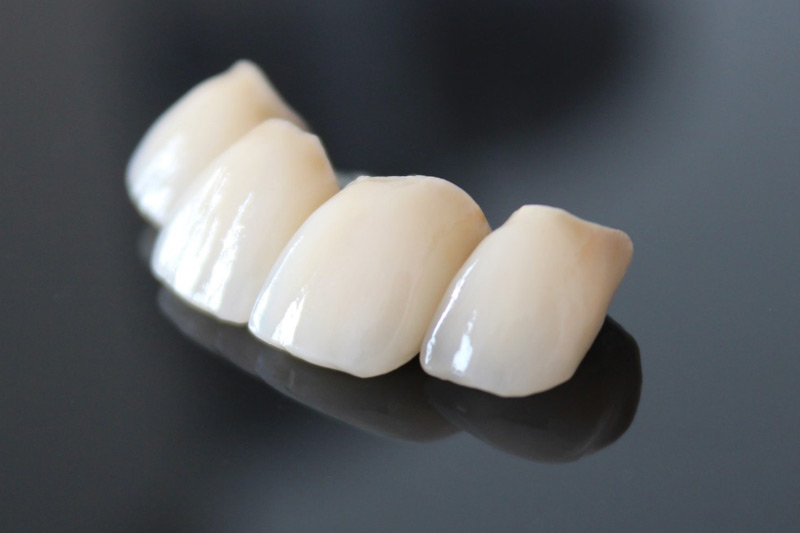 All-Ceramic Crown Restoration: Durable and Strong, Restoring Natural Beauty