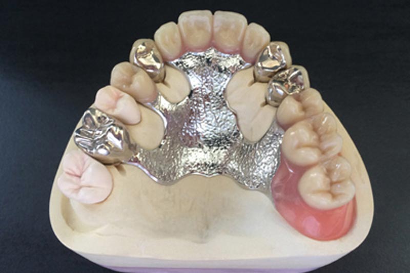 Metal Framework Denture: A Durable and Long-Lasting Restoration Choice