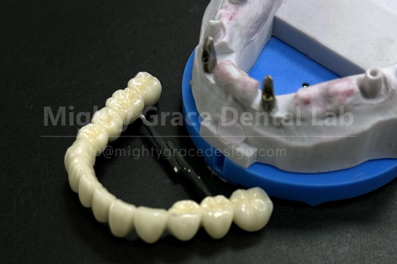 Restoring a Complete Dentition: Dental Implant Bridges, A Modern Solution for Multiple Missing Teeth