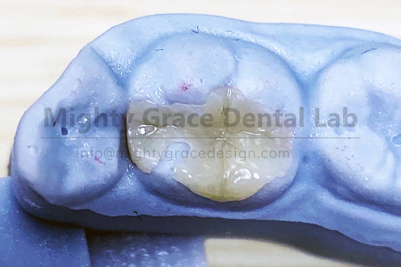 Say Goodbye to Repeated Fillings: Porcelain Inlays Offer a More Lasting Restoration