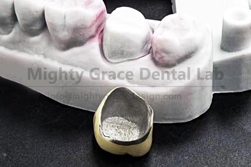 A Time-Tested Restoration: Sturdy and Reliable Porcelain-Fused-to-Metal Crowns