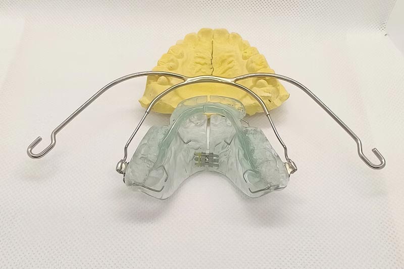 Professional Interpretation: How the Van Beek Functional Appliance Corrects Deep Overjet and Class II Malocclusion