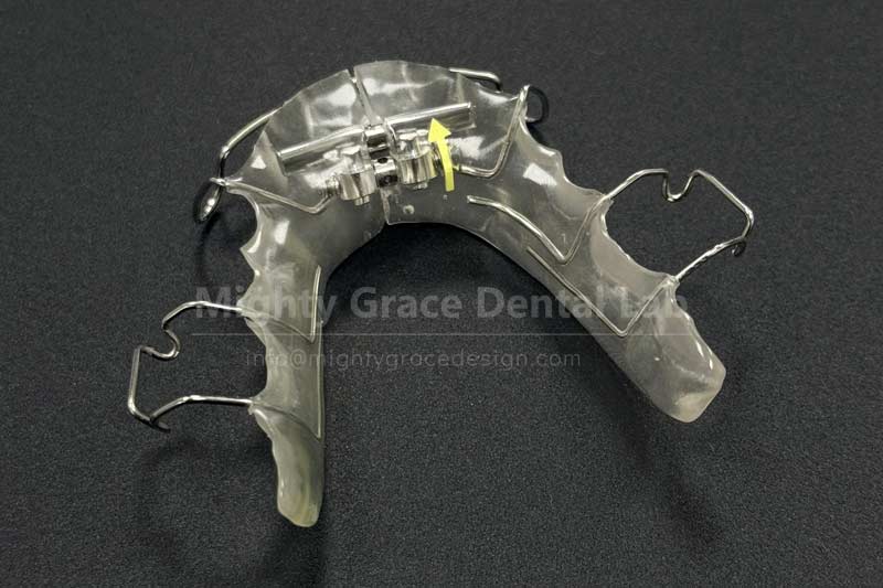 Focusing on Anterior Arch Narrowness Correction: The Fan-shaped Expander Seizes the Golden Opportunity for Treatment During the Mixed Dentition Period