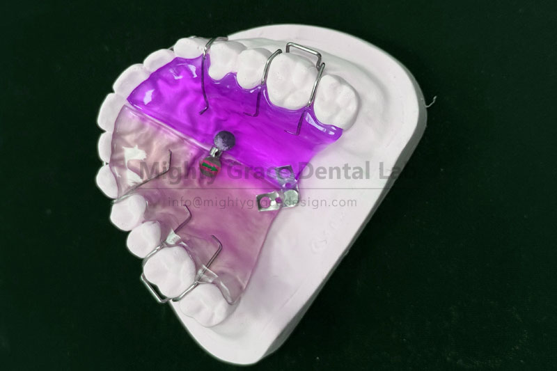 Focusing on Anterior Arch Narrowness Correction: The Fan-shaped Expander Seizes the Golden Opportunit