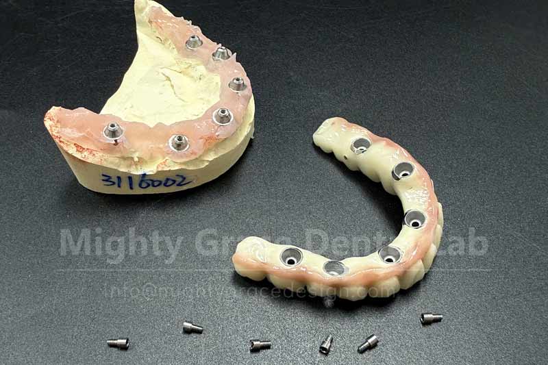 A Full Arch of Healthy Teeth in Just One Day – All-On-X Makes Dental Restoration No Longer a Lengthy Process