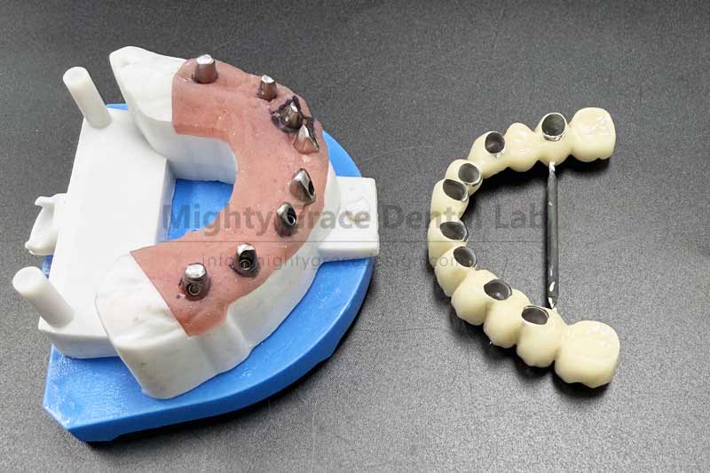 Implant-Supported Bridge: A Restoration Method That Restores Chewing Force with Aesthetic Consideration