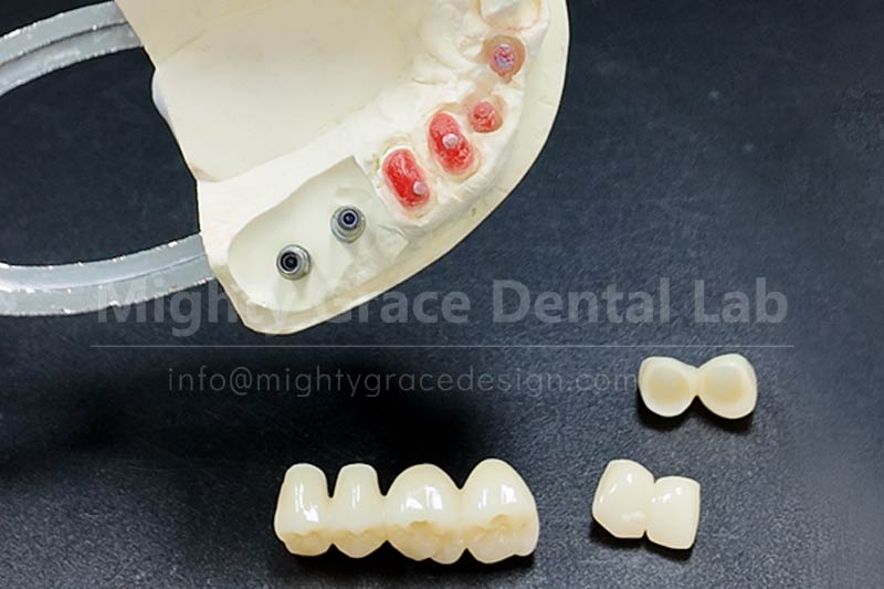 All-Ceramic Crowns – Make Restored Teeth as Natural as Real Teeth