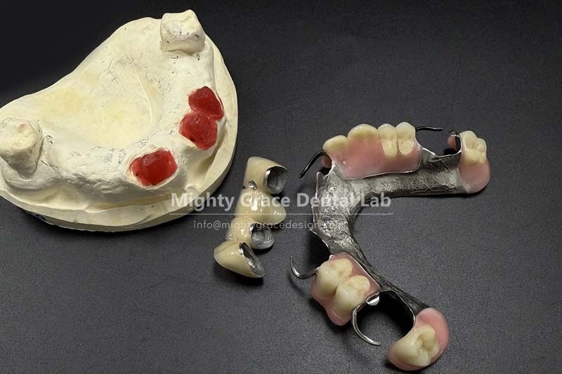 Bite firmly, stay stable – a cast partial denture gives you peace of mind for ten years.
