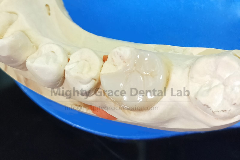 Tired of repeated fillings? Try the ceramic inlay – a custom-made restoration block.