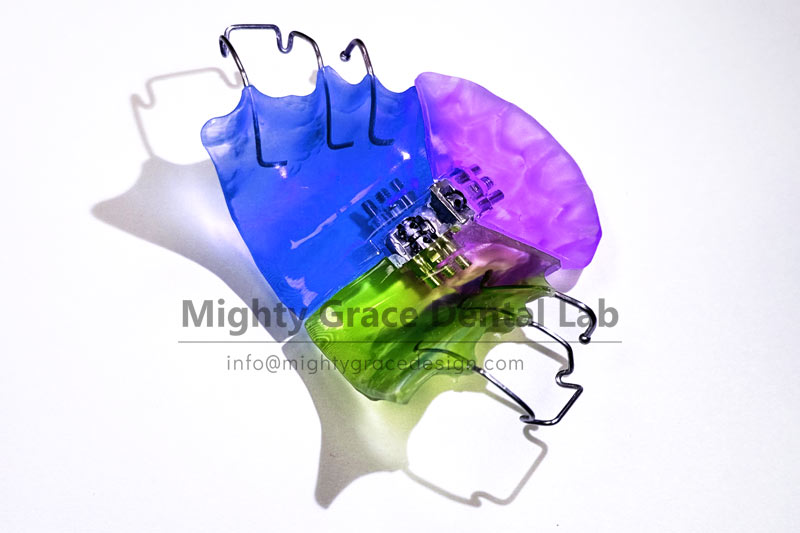 Missed the mixed dentition period? Don’t give up – the Three-dimensional Expander can still open up your dental arch.