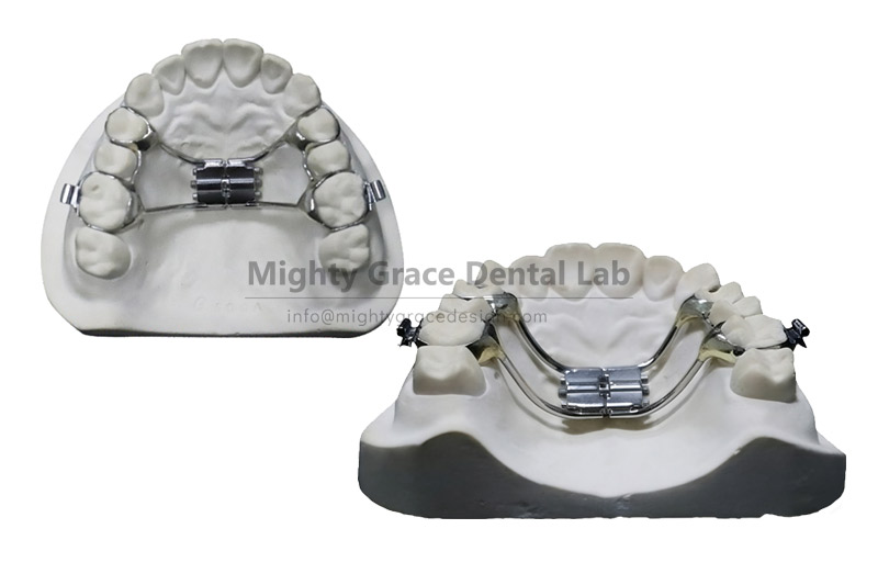 Hyrax Rapid Expander – Short-Term Opening of the Midpalatal Suture to Resolve Severe Crowding and Posterior Crossbite