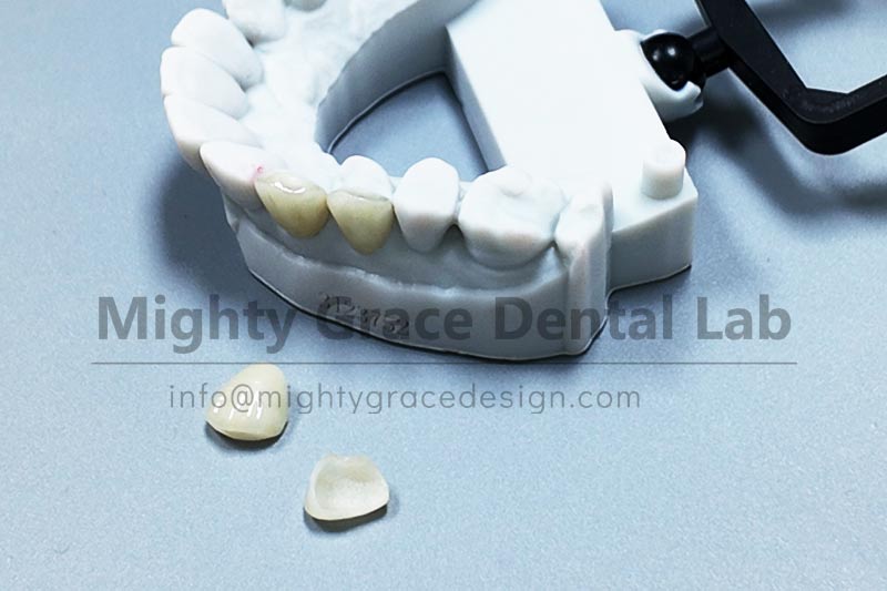 Don't let yellowed or chipped teeth hold back your smile – porcelain veneers can help.