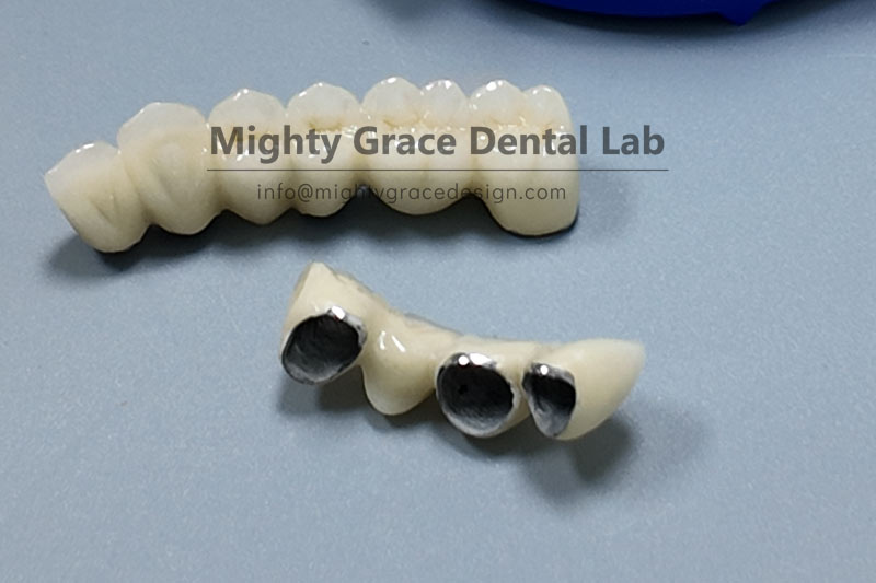 For posterior tooth restoration, you can't go wrong with PFM crowns – they are tough enough