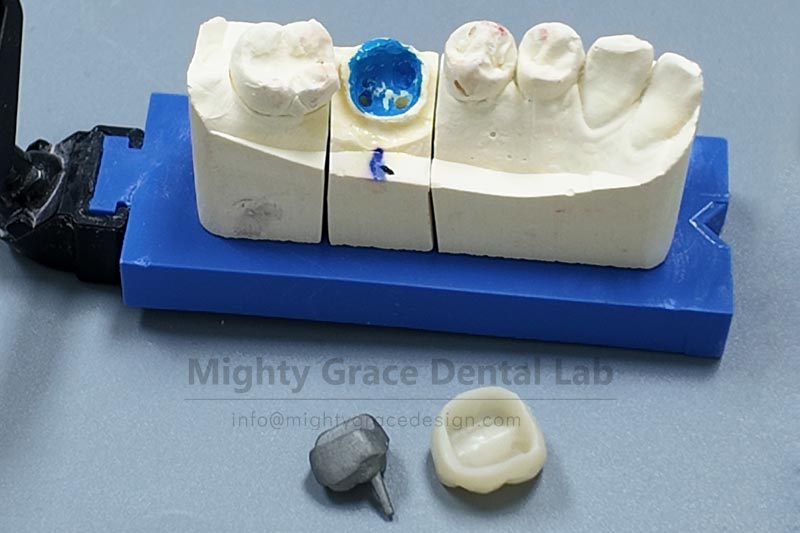 All-ceramic crowns combine aesthetics and strength – no need to be overly cautious after restoratio