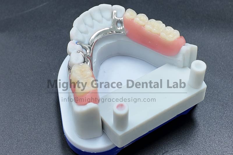 Don't want to grind down healthy adjacent teeth? A removable partial denture with a metal framework provides stable support.