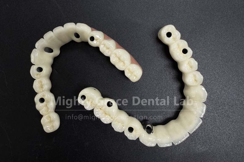 Multiple missing teeth? Choose an implant-supported bridge – it saves money and spares you trouble.
