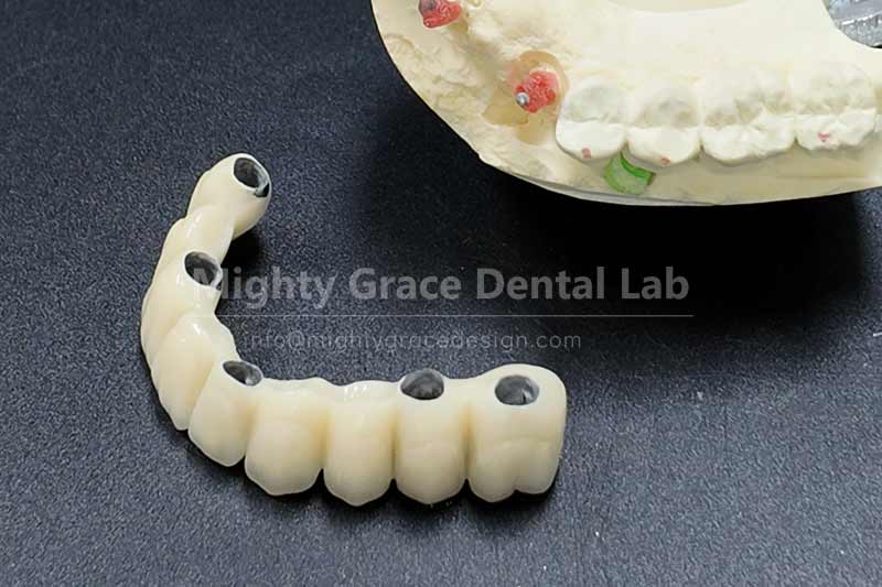 Say Goodbye to Removable Dentures – All-On-X Implants Deliver Steady, Reliable Confidence