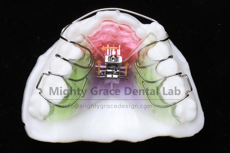 Three-dimensional Expander: Correcting Narrow Dental Arch and Anterior Crossbite at the Source