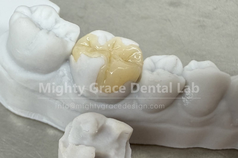 Say goodbye to repeated fillings—try ceramic inlays.