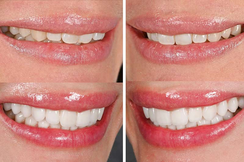Porcelain Veneers Should Stay Like New Long-Term: Don’t Cut Corners on Cleaning and Regular Checkup