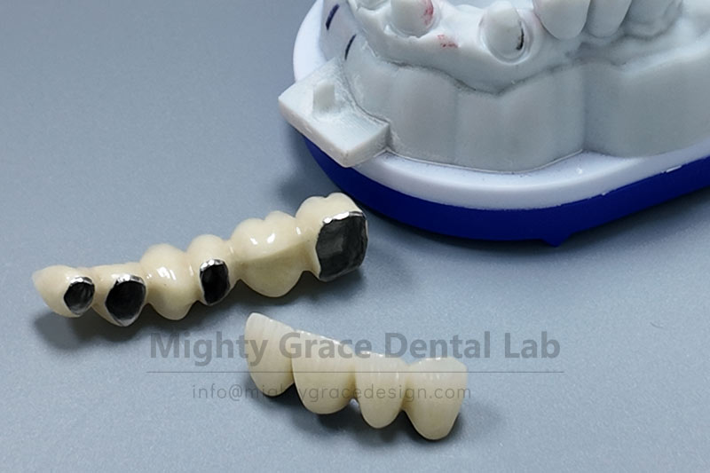 Porcelain-Fused-to-Metal (PFM) Crowns: Protecting Every Damaged Tooth with Durability and Practicality