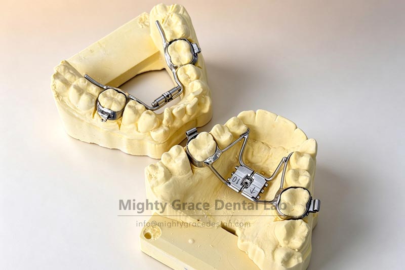 Hyrax Rapid Expander: Efficiently Addressing Narrow Dental Arches and Building a Foundation for a Beautiful Smile
